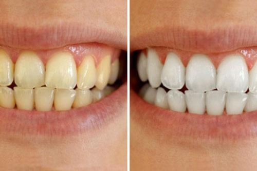 Cao răng lâu năm đến mấy cũng bong ra từng mảng, chấm dứt hôi miệng đến bất ngờ chỉ trong 5 phút!