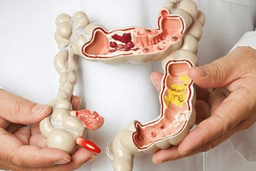 Trĩ ngoại có nguy cơ chuyển sang ung thư?