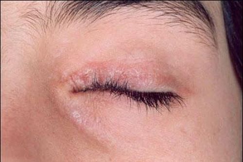Bệnh vảy nến vùng mắt - Cẩn thận biến chứng