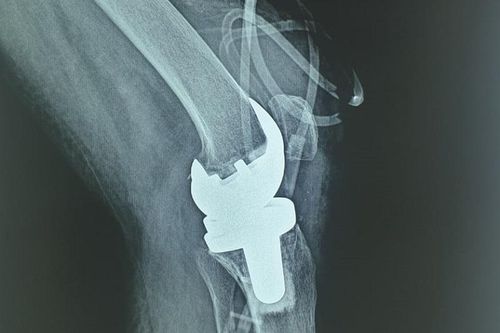 Lần đầu tiên thay khớp gối nhân tạo cho người mắc lao khớp gối