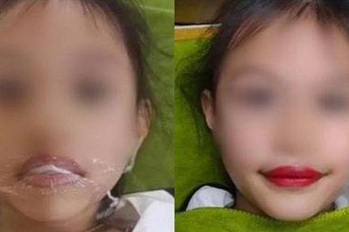 Biến chứng kinh hoàng có thể xảy ra khi xăm môi cho trẻ 5 tuổi