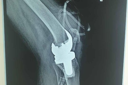 Lần đầu tiên bác sỹ Việt Nam thay khớp gối nhân tạo cho người mắc lao