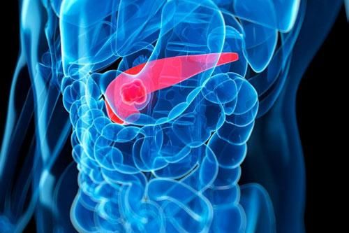 Dấu hiệu cảnh báo ung thư tuyến tụy giai đoạn cuối