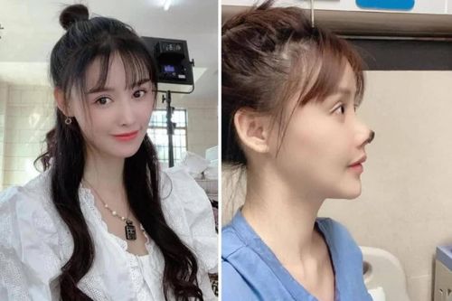 Nữ diễn viên Trung Quốc hoại tử mũi vì phẫu thuật thẩm mỹ khiến cư dân mạng sợ hãi