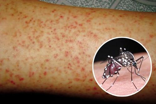 Sốt xuất huyết bao lâu thì khỏi? Dấu hiệu nhận biết