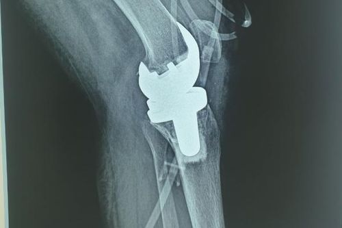 Lần đầu tiên thay khớp gối nhân tạo cho bệnh nhân lao khớp gối