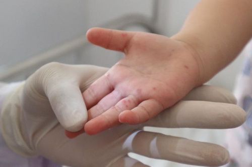Hà Nội: 28 quận, huyện, thị xã có ca mắc tay chân miệng