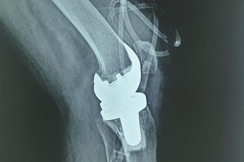 Lần đầu tiên Việt Nam phẫu thuật thành công thay khớp gối nhân tạo