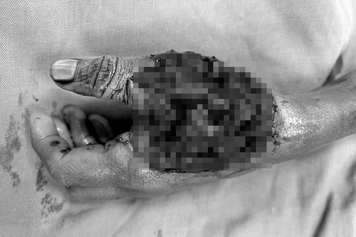 Bé trai bị rách giác mạc, hai bàn tay dập nát do tự nối pin gây phát nổ
