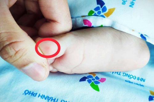 Nhập viện sau 4 ngày nôn ói, bé 6 tuổi phát hiện bị tay chân miệng mức nặng
