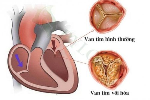 Biến chứng nguy hiểm của vôi hóa van tim