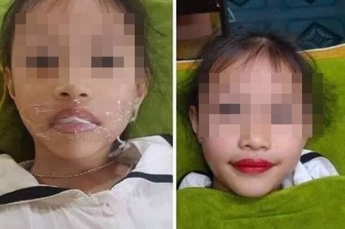 Nguy hiểm khi xăm môi cho trẻ nhỏ