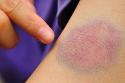 Dấu hiệu hiệu điển hình nhất của 1 căn bệnh ung thư