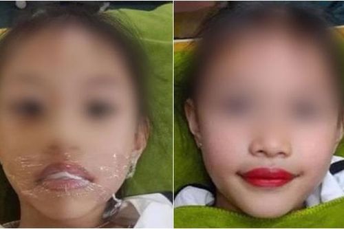 Phun môi collagen cho bé 5 tuổi có thể dẫn đến những hệ lụy nguy hiểm nào?
