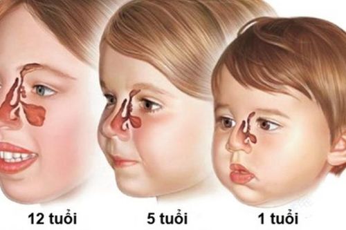 Trẻ em có bị viêm xoang?