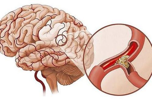 Nguyên nhân gây thiếu máu não