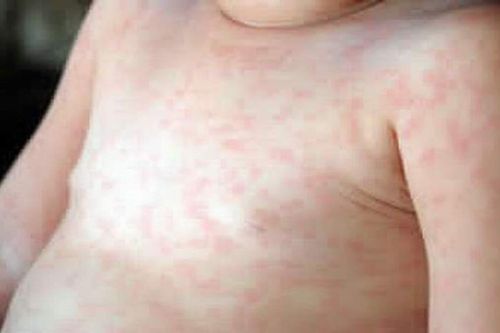 Trẻ phát ban sau sốt: những lưu ý quan trọng cha mẹ cần biết