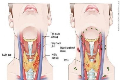 Tất tần tật các bệnh thường gặp về họng và cách phòng tránh