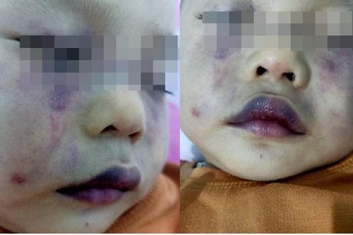 Nghi vấn người phụ nữ ở cơ sở giữ trẻ bạo hành bé trai dã man khiến khuôn mặt bầm dập nặng