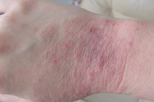 Điều trị vảy nến đúng cách