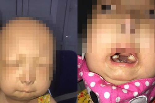 Phát hiện bé gái mắc hội chứng 'con báo' đầu tiên tại Việt Nam