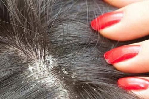 3 cách trị gàu mảng dứt điểm tại nhà