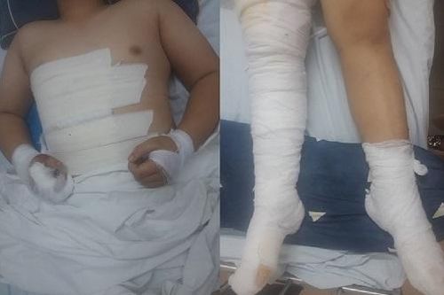 Mê bẫy chim, bé trai bị điện giật gây tổn thương nghiêm trọng