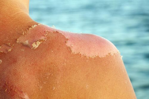 Chuyên gia cảnh báo da bị 'cháy nắng' có thể gây ung thư da