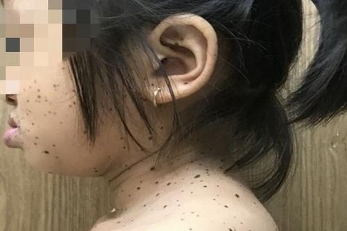 Bệnh nhân đầu tiên ở Việt Nam mắc hội chứng da báo