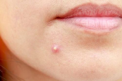 5 công thức trị mụn trứng cá tại nhà đơn giản