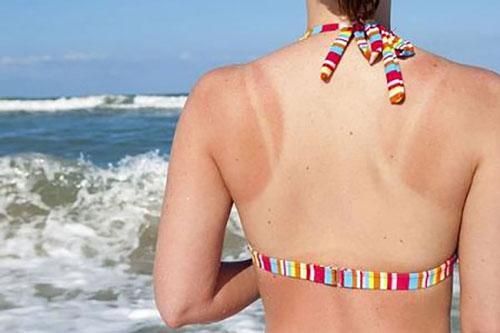 4 nguyên liệu nhà bếp phục hồi làn da cháy nắng hiệu quả