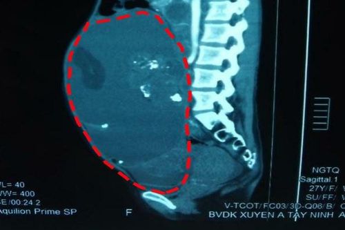 Bóc tách khối bướu 16 kg khỏi bụng người bệnh