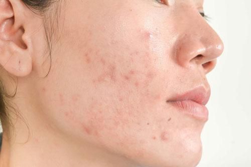4 nguyên tắc 'vàng' để hết thâm mụn ngay tại nhà