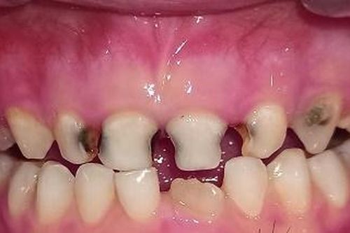 Sâu răng sữa ở trẻ trước tuổi tới trường là hơn 90%, chuyên gia nói gì?