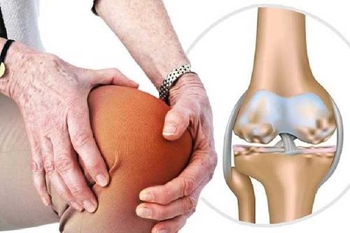 Cách trị thoái hóa khớp gối không dùng thuốc
