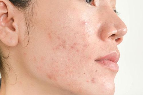 Hết thâm mụn chỉ bằng cách dùng nha đam