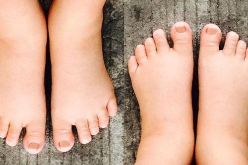 Chân bị phù coi chừng bệnh nguy hiểm
