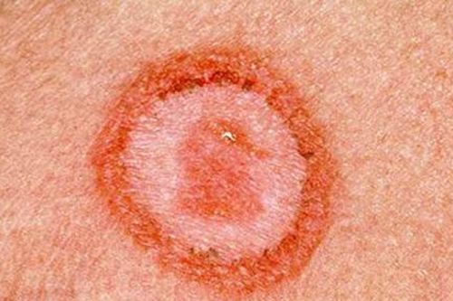 Ghi nhận một trường hợp mắc giang mai ở vú hiếm gặp