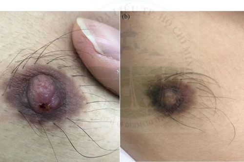 Mắc bệnh giang mai hiếm gặp sau khi 'quan hệ' đồng tính nam