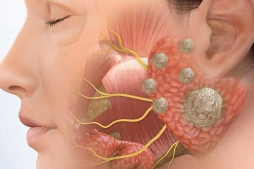 Nhận biết ung thư tuyến nước bọt giai đoạn sớm