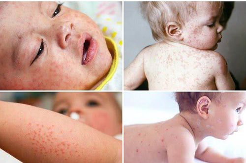 Mắc bệnh Rubella phải kiêng tắm gội không?