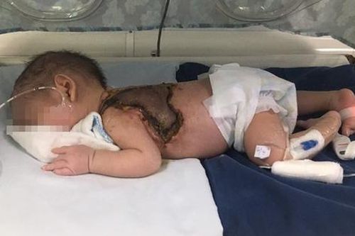 Mẹ dùng kim khâu chích mụn cho con, bé sơ sinh bị nhiễm trùng huyết, hoại tử lưng