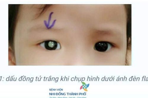 Cẩn trọng với bệnh ung thư nguyên bào võng mạc ở trẻ em