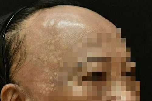 Ca bệnh hiếm gặp, bệnh nhân rụng tóc xơ hóa vùng trán