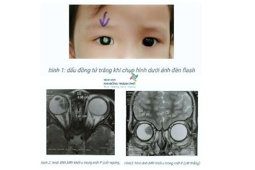 Cảnh giác với căn bệnh ác tính thường gặp ở trẻ nhỏ