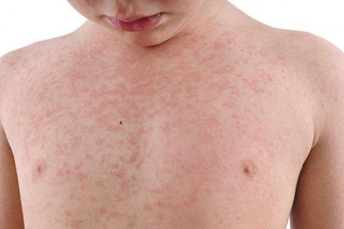 Thận trọng với các biến chứng của bệnh Rubella