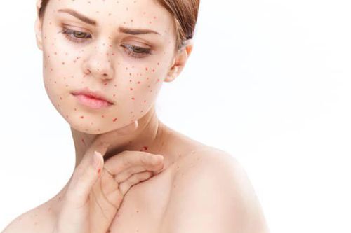 Bệnh Rubella bao lâu thì khỏi?