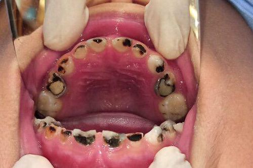 Điểm mặt các nguyên nhân gây sâu răng ở trẻ, cha mẹ biết mà phòng tránh cho con