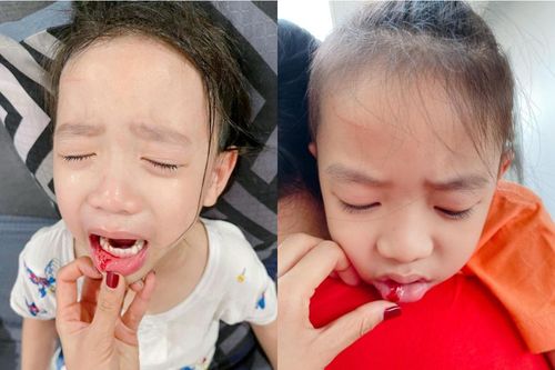 Con trai Ốc Thanh Vân gặp tai nạn chảy máu sưng miệng