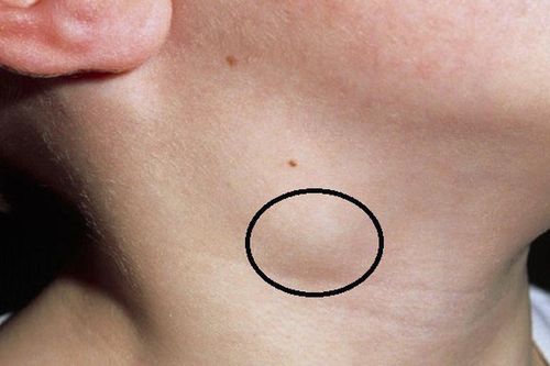 Rubella bị sưng hạch: Sưng hạch do bệnh Rubella có nguy hiểm không?